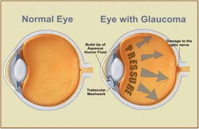Glaucoma: The Silent Thief of Sight - How to Detect It Early